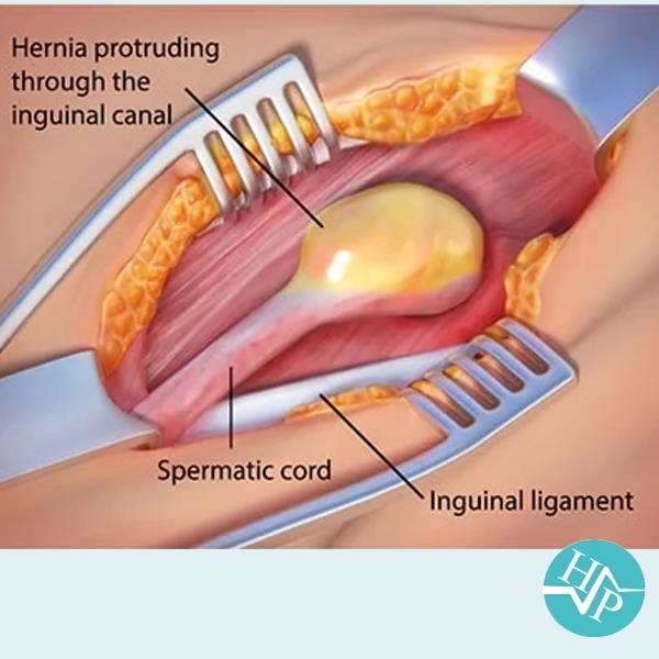 https://www.harleysurgicalpractice.co.uk/images/procedure/gallery/hernia-01.JPG