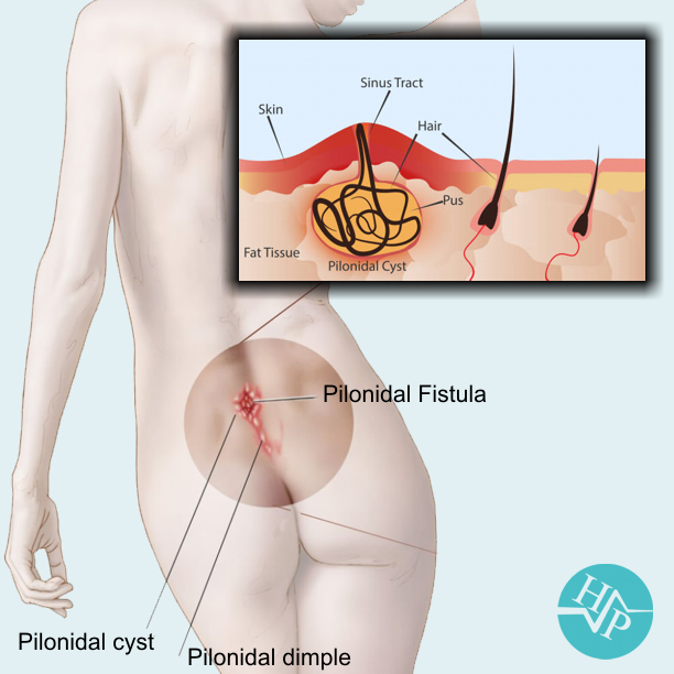 Pilonidal Cyst Drainage - Diagnosis And Treatment